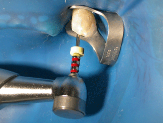 Fig. VI: Instrumento ProFile Orifice Shaper 3 iniciando la preparacíon corono-apical del conducto mesiovestibular.