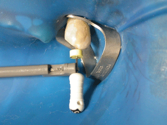 Fig. VII: Conductometría electrónica realizado en el conducto mesiovestibular.