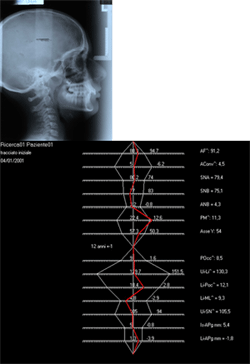 Fig 5 (a-b): Análisis cefalométrico inicial según Illinois