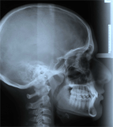 Fig 6 (a-b): Análisis cefalométrico intermedio (según Illinois)