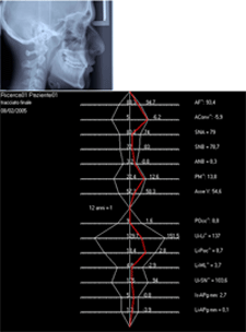 Fig 7 (a-b): Análisis cefalométrico final (según Illinois)