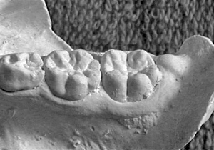 Figura 11. Protostílido segundo molar inferior temporal y primer molar inferior permanente expresión punto P o foramen secum.
