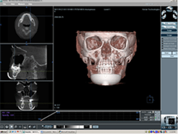 Fig. 7 Imágenes de reconstrução em 3D do aparelho I-CAT