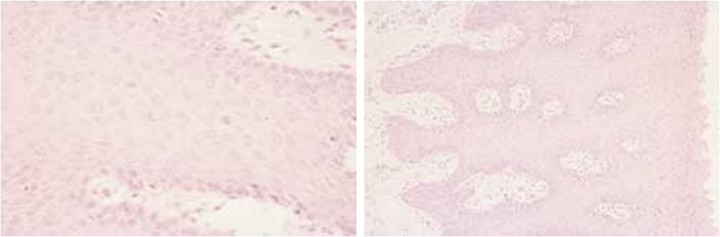 Fig. 3 y 4 Imágenes histopatológicas donde se evidencia la hiperplasia epitelial, alargamiento de los mamelones epiteliales y las figuras mitosoides