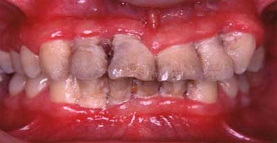 Una higiene inadecuada, con presencia de placa y bacterias puede ser la etiología de la lesión.