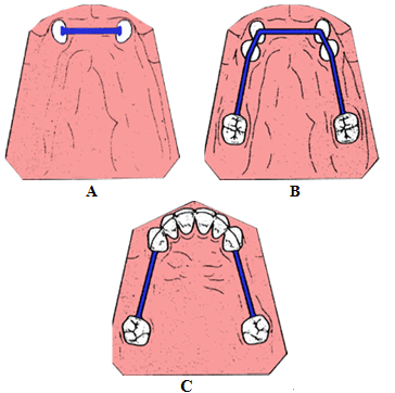 Figura Nº 1.- A: sobredentadura; B: ferulización en arco cruzado;  C: Brecha de gran extensión . Fuente: http://www.preat.com/p_bar_instruct.htm