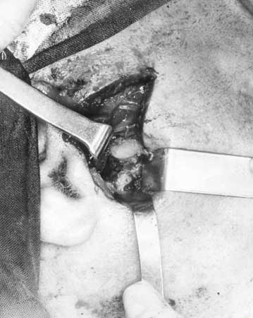 Fig. 5 Incisión preauricular con extensión anterior en el extremo superior en ángulo de 45 grado