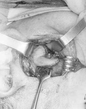 Fig. 6 Aspecto quirúgico de una Anquilosis temporomandibular