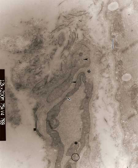 Fig. 1 En esta micrografía electrónica se aprecia una sección de capilar con diferencias en el grosor de la pared endotelial, una distribución variada de vesículas pinocíticas (o) y caveólas (↑). Nótese la presencia de una prolongación del citoplasma endotelial hacia la luz (☼). La membrana basal (*) está engrosada y cubierta por fibrillas de colágeno (■).Obsérvese la distribución irregular de las vesículas pinóciticas en el pericito.(▲). Barra: 0,4 µm