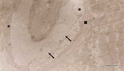 Fig. 3 En la sección se aprecia un capilar con áreas del citoplasma endotelial muy engrosadas y de baja densidad electrónica (*) y otras mas estrechas y de mayor densidad electrónica (☼). La membrana basal se presenta engrosada (■). Nótese la formación de exocitosis a partir de la membrana endotelial (↑). Barra: 1,2mµ.