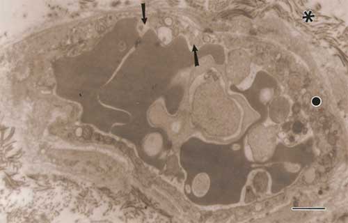 Fig. 4 En esta sección, el citoplasma endotelial se aprecia con proliferación de organelas (●) y pérdida de la membrana plasmática con salida hacia la luz de las organelas (↑). Nótese lo abundante del colágeno (*). Barra: 1µm.