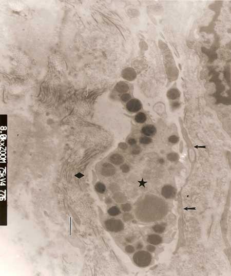 Fig. 5 Obsérvese el mastocito (☼) en el espacio limitado por las prolongaciones de un macrófago (↑) y numerosas fibrillas de colágeno (◆). Barra: ,6µm
