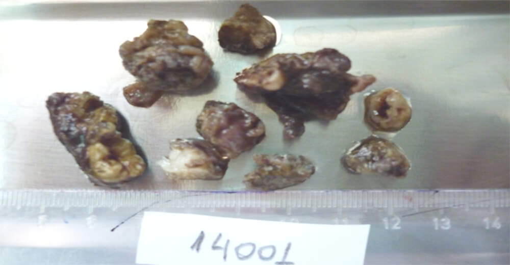 Figura 6: Imagen Macroscópica: varios fragmentos irregulares, el mayor de 2,5 x 2 cm, de consistencia ósea, revestidos por delgada capa de tejidos blandos. Acompañan algunos restos dentarios que se hallan incluidos en el material (2do molar) con reabsorción parcial.