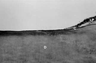 Fig: 4 Grupo IV: Capa de cemento presente en la superficie radicular en el área sometido a la remoción del ligamento periodontal. H.E. - 160x.