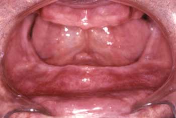 Figura 3 Reborde alveolar mandibular, tres meses después de la cirugía
