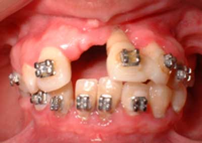 Figura 2 Mordida Anterior