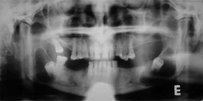 Fig. 1 Radiografía panorámica preoperatoria donde se observan dos lesiones radiolúcidas uniloculares, de bordes bien definidos, asociadas a los dos terceros molares inferiores impactados.