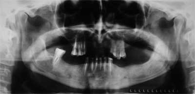 Fig. 4 Radiografía panorámica con 3 meses de post-operatorio donde se evidencia una reducción significativa del tamaño de las lesiones quísticas, con regeneración ósea, observando como principal diferencia entre las dos regiones una mayor radiopacidad del lado izquierdo donde fue realizada la descompresión.