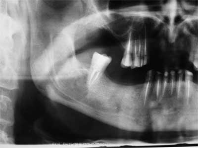Fig. 5 Aproximación de la radiografía panorámica del lado derecho con 4 meses de post-operatorio, donde se puede observar la regeneración ósea pero con posibilidad de distinguir donde se encontraba localizada la lesión quística.