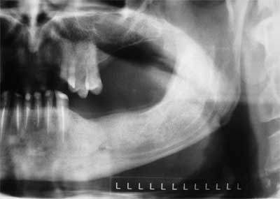 Fig. 6 Aproximación de la radiografía panorámica del lado izquierdo con 4 meses de post-operatorio, donde se puede observar la total regeneración ósea sin posibilidad de distinguir donde se encontraba ubicado el quiste dentígero.