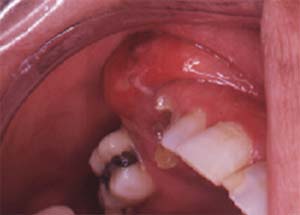 Figura 2 Absceso dentoalveolar asociado a restos radiculares del 1.3 y 1.4.
