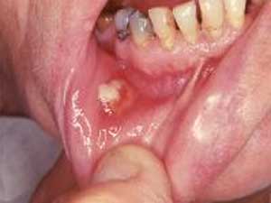 Figura 3: Imagen en donde se muestra la fistula causa por una lesion por actinomicosis Tomado de: www.emedicine.com/ derm/topic767.htm