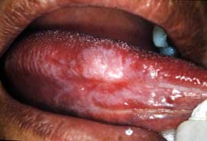 Foto 1: Borde lateral de lengua y piso de boca lateral derecho. Se puede observar placa blanca, zonas rojas atróficas periféricas, lesiones verrugosas, estrías verticales posteriores
