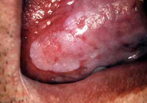 Foto 2: Tumor verrugoso blanco amarillento, con aspecto de coliflor, base indurada (Zona B). Por delante excrecencias redondeadas, con aspecto de gránulos (Zona C).
