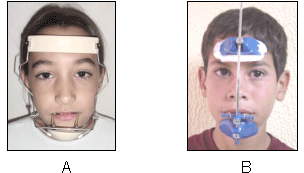 Fig. 2 Máscara facial: A) modelo de Delaire y cols(2), B) modificación de Petit(3)