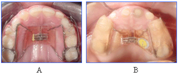 Fig.3 Aparatos de expansión palatina. A) Tipo Hass modificado, B) férula adherida