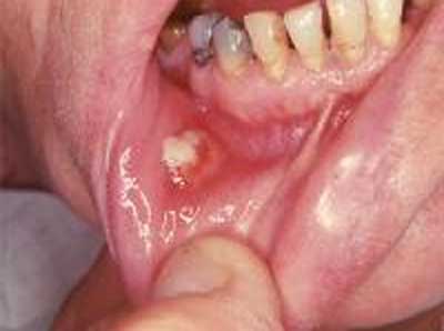 Figura 3 Imagen en donde se muestra la fistula causa por una lesion por actinomicosis Tomado de: www.emedicine.com/ derm/topic767.htm