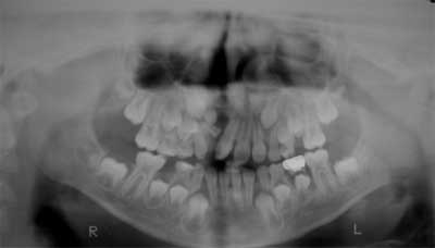 Foto N°1 Radiografía preoperatoria