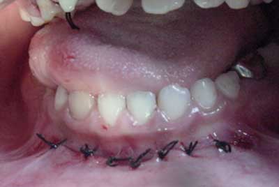 Foto N° 10 Síntesis de tejidos posterior a la toma del injerto óseo en mentón.