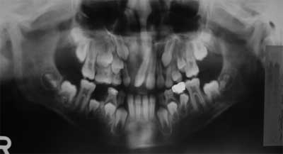 Foto N°2 Radiografía del postoperatorio