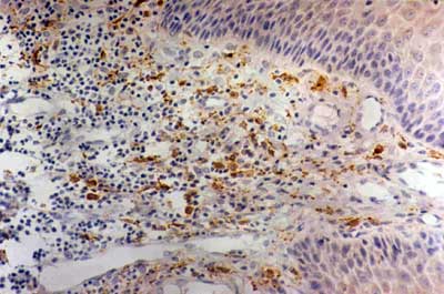 Figura 1. Gingivitis crónica - células CD68+ difusamente distribuidas en posición yuxtaepitelial y en áreas más distantes del epitelio / score 2 (SABC - 200x).