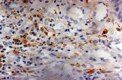 Figura 2. Gingivitis crónica - detalle de las células inmuno marcadas próximo del epitelio (SABC - 400X).