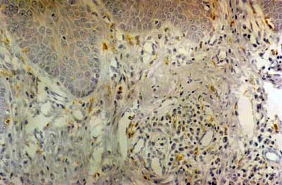 Figura 3. Periodontitis crónica - distribución difusa de las células CD68+ próximo y en áreas más distantes del epitelio / score 1 (SABC - 200x).