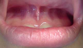 Fig. 1 AFV ubicado en la parte más inferior del frenillo vestibular con forma lobular.