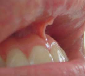 Fig. 2 AFV insertado en la zona superior del frenillo vestibular.