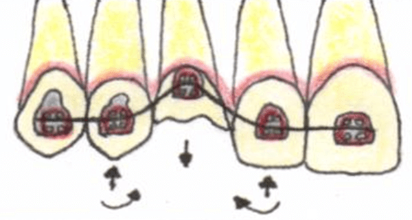 Fig. 1. Efectos producidos por un arco continuo flexible durante la erupción forzada de un diente.