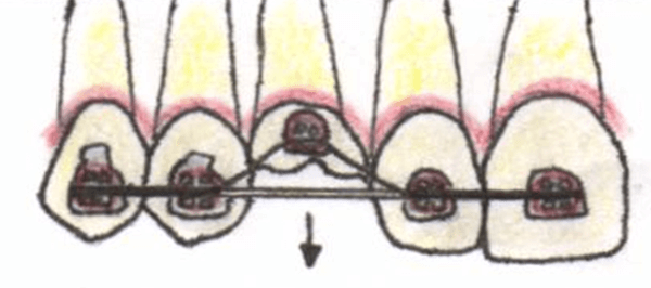 Fig. 3. Esquema del uso del doble arco en la erupción forzada de un canino superior.