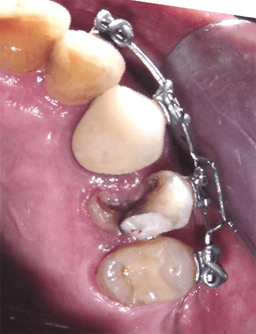 Fig. 9 Doblez de cajuela