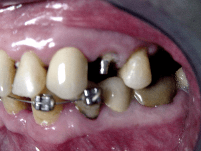 Fig. 16 Corona definitive. Vista lateral