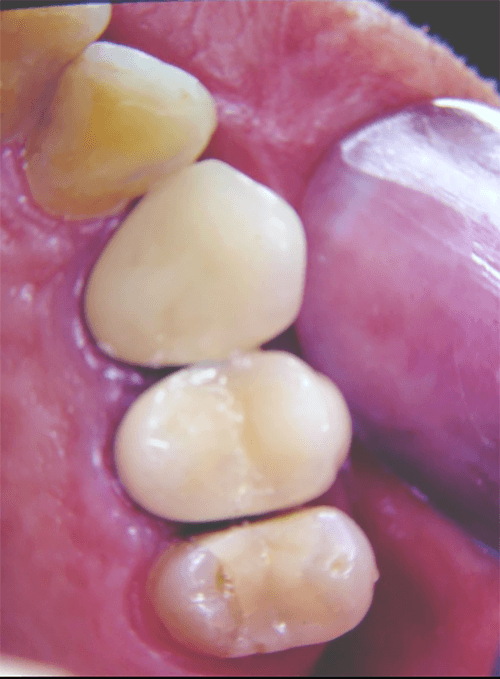 Fig. 17 Vista oclusal
