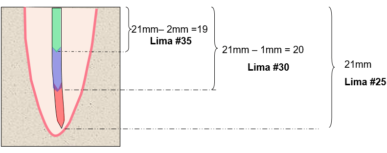 FIGURA 5  Limpieza y conformación de la porción apical posterior al ensanchamiento básico del mismo con limas #10, #15 y #20 a longitud de trabajo definitiva (21mm), utilizando la Técnica “Step-Back”.  Con la lima #25 se establece el asiento apical para luego proceder con las limas #30 y #35, acortadas 1mm y 2mm respectivamente  de la longitud de trabajo, culminar la preparación del tercio apical.