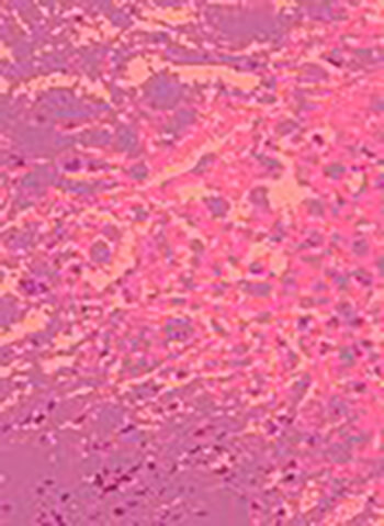 Fig. 1 Aspecto histopatológico. La microscopía de luz revela capas de células que no presentan un patrón arquitectónico y muestran anomalías celulares intensas que consisten en hipercromatismo y pleomorfismo, alteración en la relación núcleo/citoplasma, gigantismo nuclear así como figuras mitóticas unipolares, bipolares y multipolares.