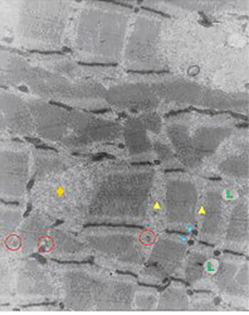 Fig. 4 Presencia de amplios espacios intermiofibrilares (triángulo). La fibra IIA presenta tríadas prominentes (circulo), mitocondrias (flechas) de un contenido electrondenso, glucógeno particulado (rombo) y gotas lipídicas (L). X 26.700