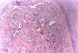 Figura 5. Caso perteneciente al grupo irrigado con agua destilada. Nótese la presencia de un infiltrado inflamatorio y congestión en la zona interradicular. H&E 10x