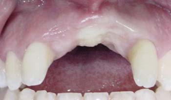 Fig. 1 Imagen preoperatoria donde puede apreciarse la atrofia existente en la región anterior del reborde alveolar.