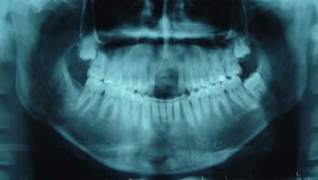 Fig. 2 Radiografía panorámica preoperatoria donde se evidencia la falta en altura ósea necesaria para la colocación de implantes oseointegrados.